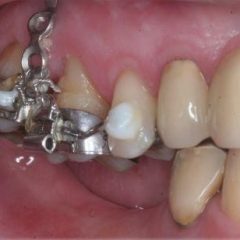 Imagem da notícia: Ancoragem Ortod&ocirc;ntica com Mini-implantes e Mini-placas