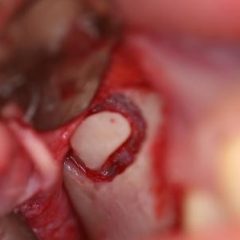Imagem da notícia: Curso de Aperfei&ccedil;oamento em Implantologia e Pr&oacute;tese sobre Implantes