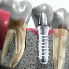 Imagem da notícia: 27&ordm; Curso de Aperfei&ccedil;oamento em Pr&oacute;tese Fixa sobre Dentes e Implantes