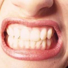 Imagem da notícia: S&iacute;ndromes gen&eacute;ticas podem alterar o posicionamento dos dentes