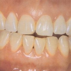 Imagem da notícia: Doen&ccedil;a periodontal atinge maioria da popula&ccedil;&atilde;o