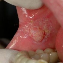 Imagem da notícia: Rastreio ao cancro oral avan&ccedil;a ainda este ano