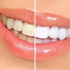 Imagem da notícia: Clareamento dental sem orienta&ccedil;&atilde;o pode trazer danos &agrave; sa&uacute;de