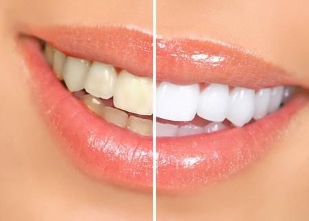 Imagem da notícia: Clareamento dental sem orientação pode trazer danos à saúde