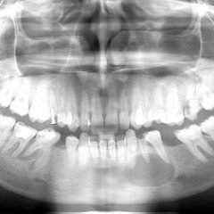 Imagem da notícia: Quistectomia mandibular de quisto periapical e cicatriza&ccedil;&atilde;o espont&acirc;nea
