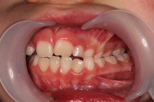 Imagem da notícia: Tratamento ortodôntico precoce da mordida cruzada posterior em dentição mista