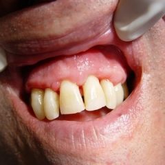 Imagem da notícia: Liga&ccedil;&atilde;o entre periodontite e doen&ccedil;as cardiovasculares