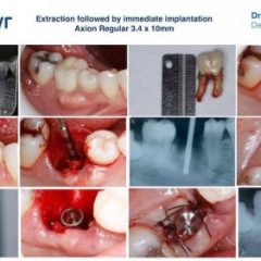 Imagem da notícia: “Capacita&ccedil;&atilde;o em Implantes Dent&aacute;rios”