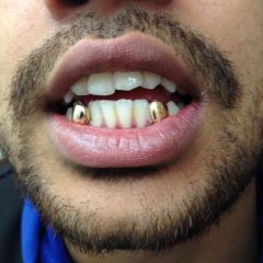 Imagem da notícia: Branqueamento dent&aacute;rio e inova&ccedil;&atilde;o acabam com ouro