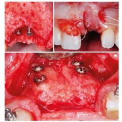 Imagem da notícia: Biotech realiza 3&ordm; Curso Intensivo Cirurgia Regenerativa em Implantologia