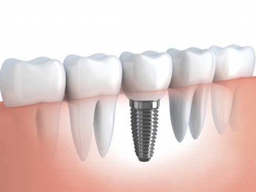 Imagem da notícia: Implantes dentários valorizam