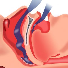 Imagem da notícia: OrisEducare e BTI dirigem curso sobre roncopatia e apneia do sono