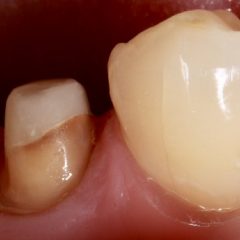 Imagem da notícia: Curso de reabilitação de dentes endodonciados com participação de Miguel Ramos e Vítor Freitas