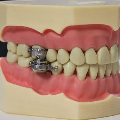 Imagem da notícia: DentalSlim Diet Control: o primeiro dispositivo dental para perda de peso