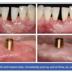 Imagem da notícia: Estudo revela que enxertos gengivais livres “podem encolher mais em torno de implantes do que dentes”