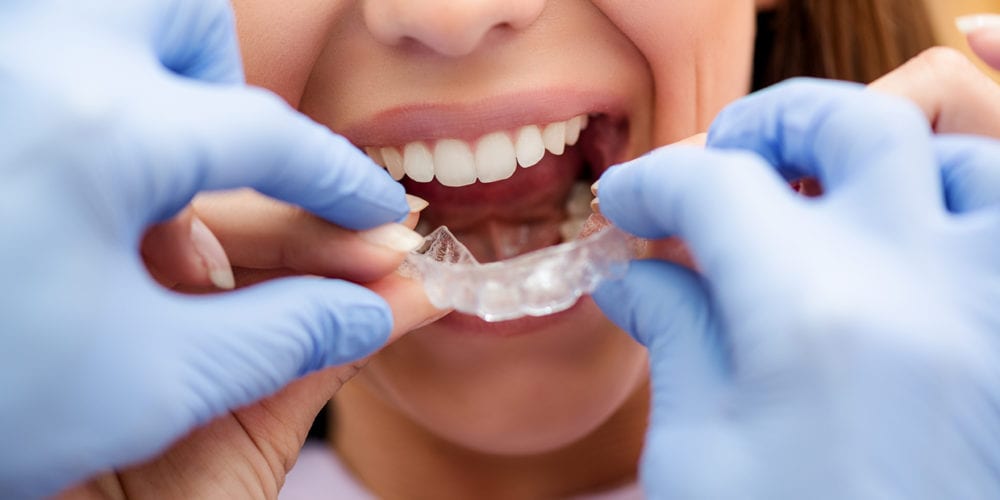 Imagem da notícia: Invisalign Go: nova plataforma e formação para médicos dentistas