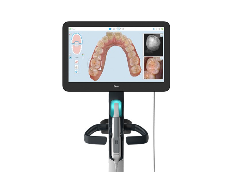 Imagem da notícia: Novo estudo clínico valida os benefícios do sistema de imagem iTero Element 5D
