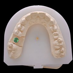 Imagem da notícia: Caso Clínico: Implantes curtos e extracurtos em setores posteriores maxilares
