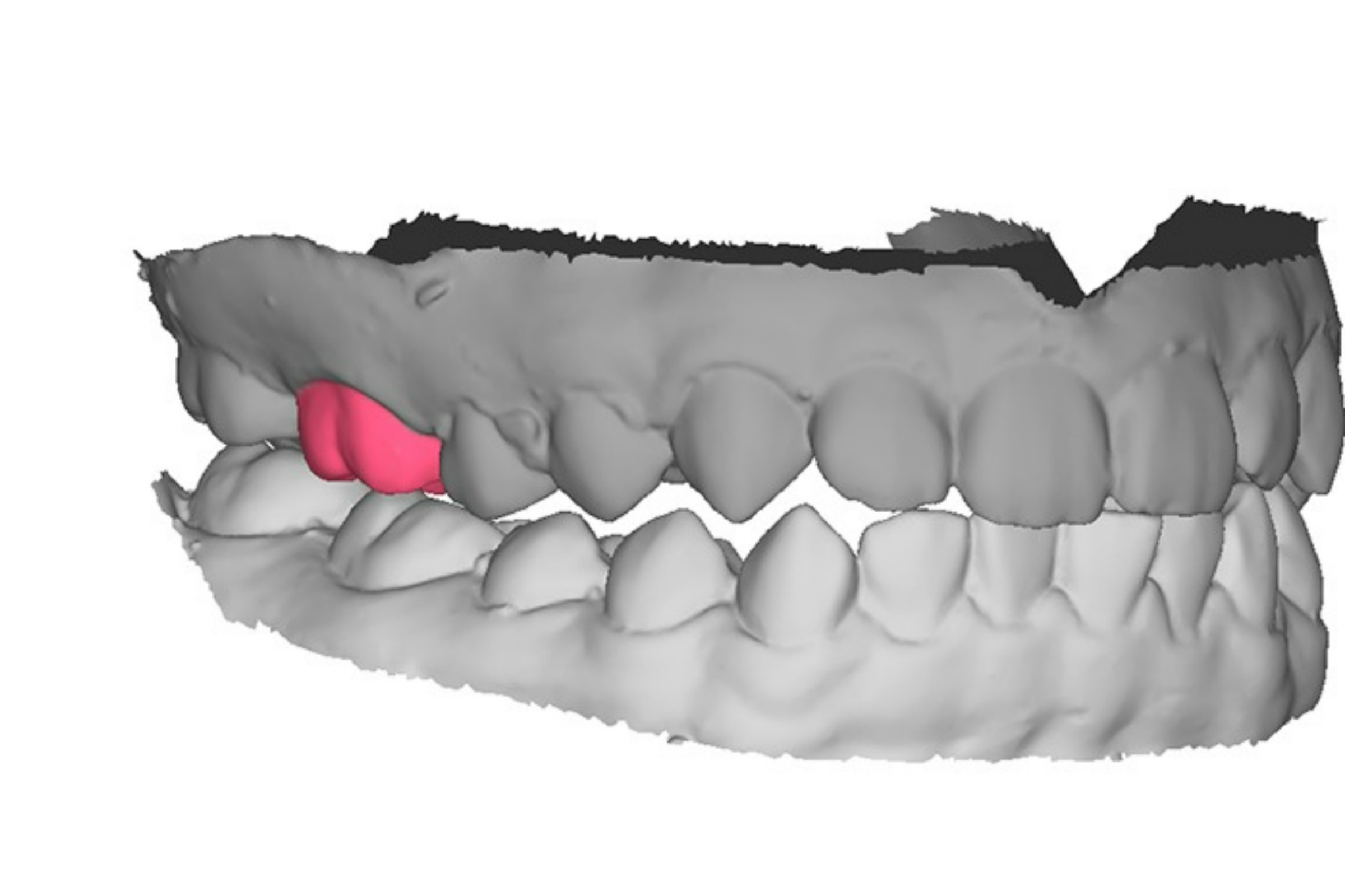 Imagem da notícia: IA pode automatizar design de próteses biomiméticas para dentes unitários