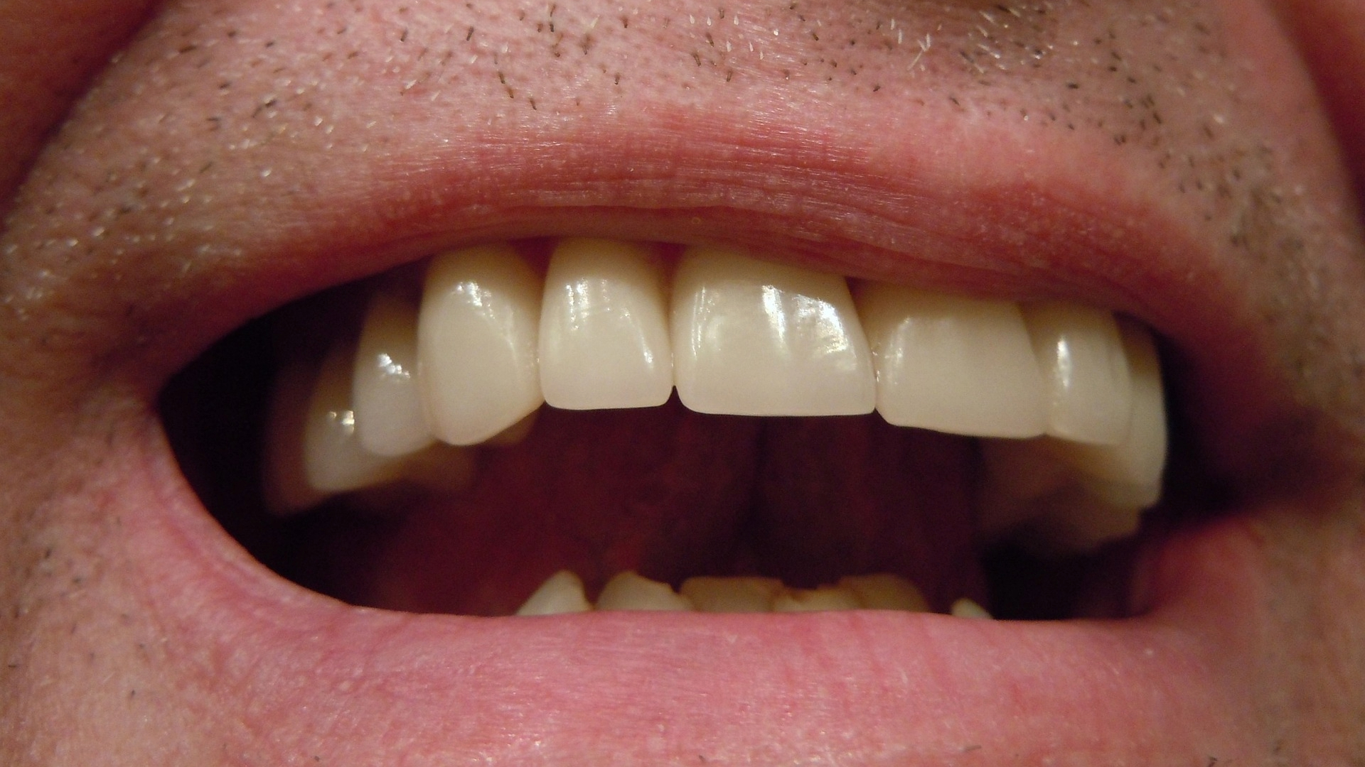 Imagem da notícia: Estudo examina perda de dentes e uso de próteses removíveis