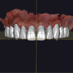 Imagem da notícia: Reabilitação total sobre implantes: quando o fluxo digital simplifica o complexo