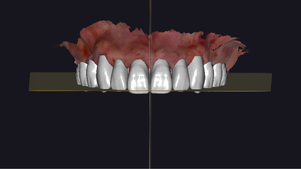Imagem da notícia: Reabilitação total sobre implantes: quando o fluxo digital simplifica o complexo
