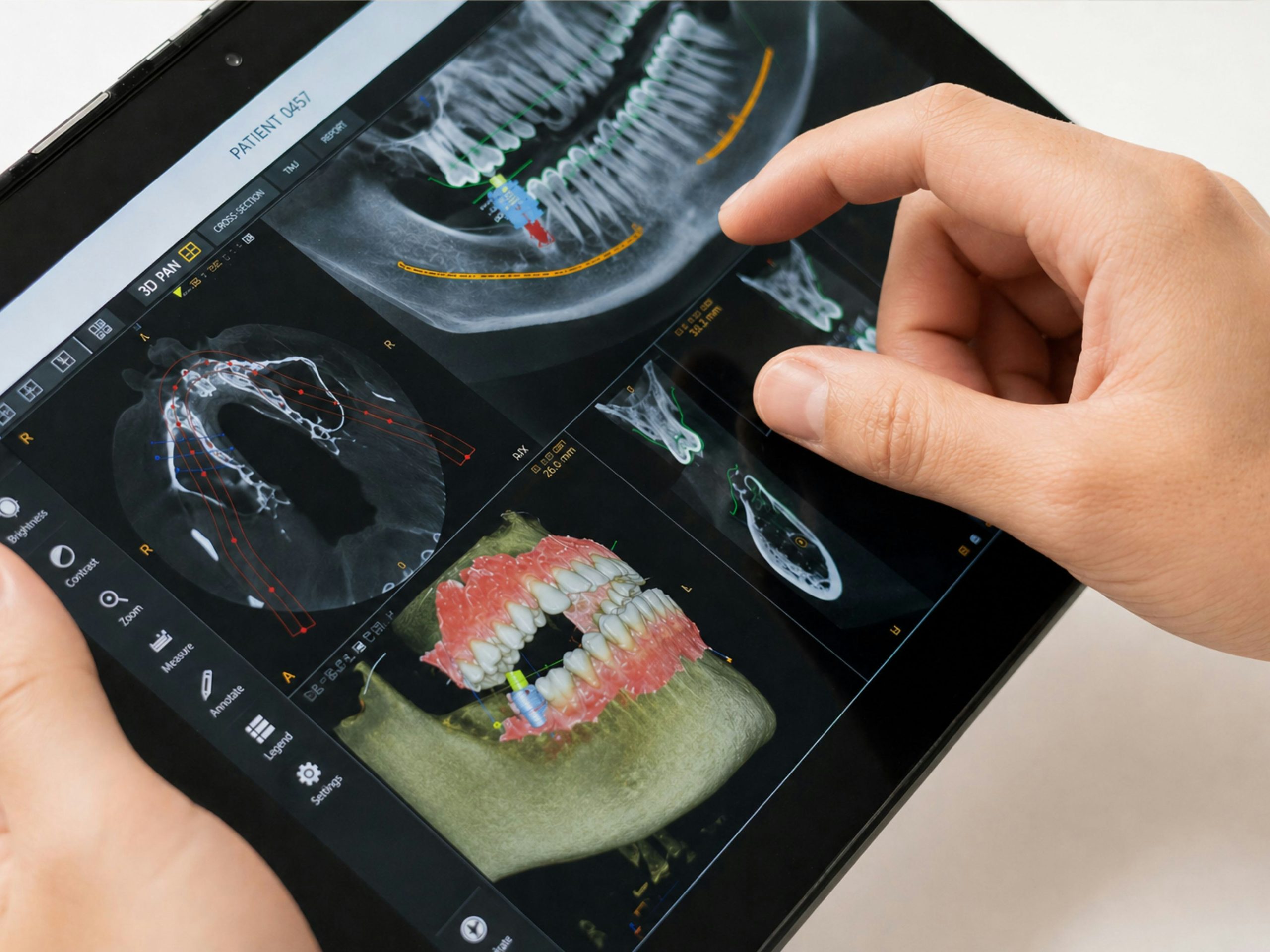 Imagem da notícia: IA aproxima-se de especialistas no planeamento de implantes