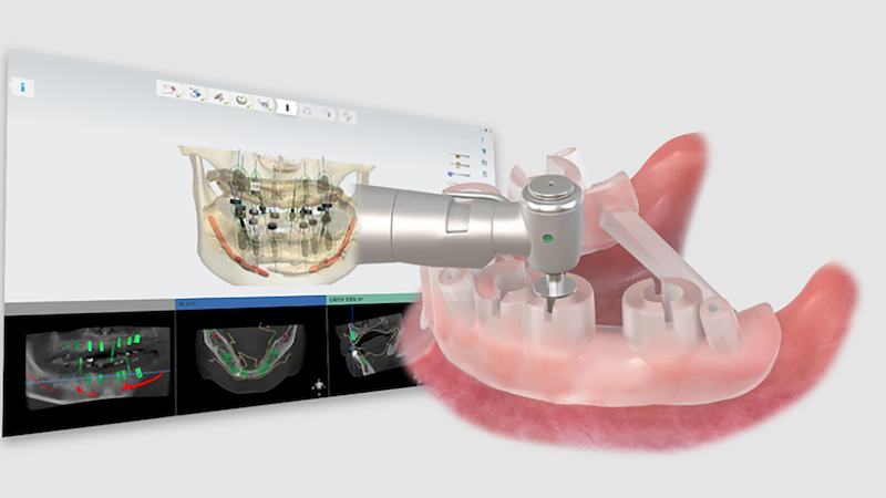 Imagem da notícia: OneGuide da Osstem Implant celebra 10.º aniversário